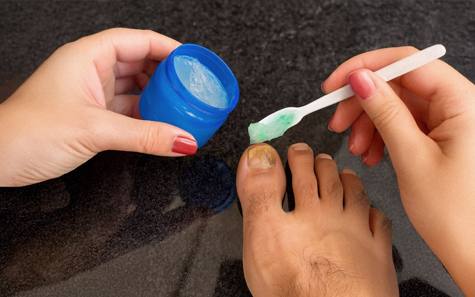 Nail Fungus Breakthrough: Why Prescriptions Fail 70% of the Time