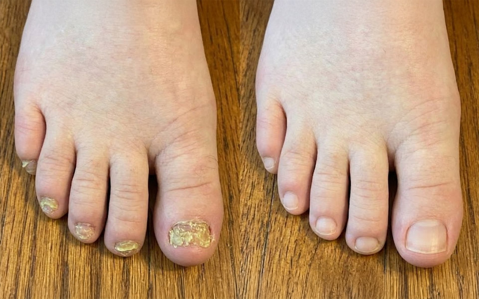 The "Fungal Fortress" That Blocks Treatment (And How to Break Through)